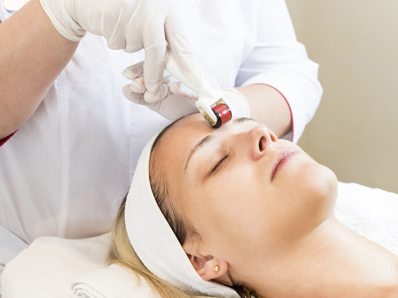 microneedling