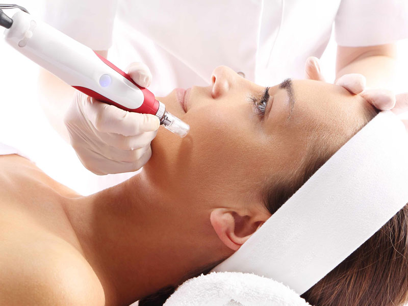 microneedling