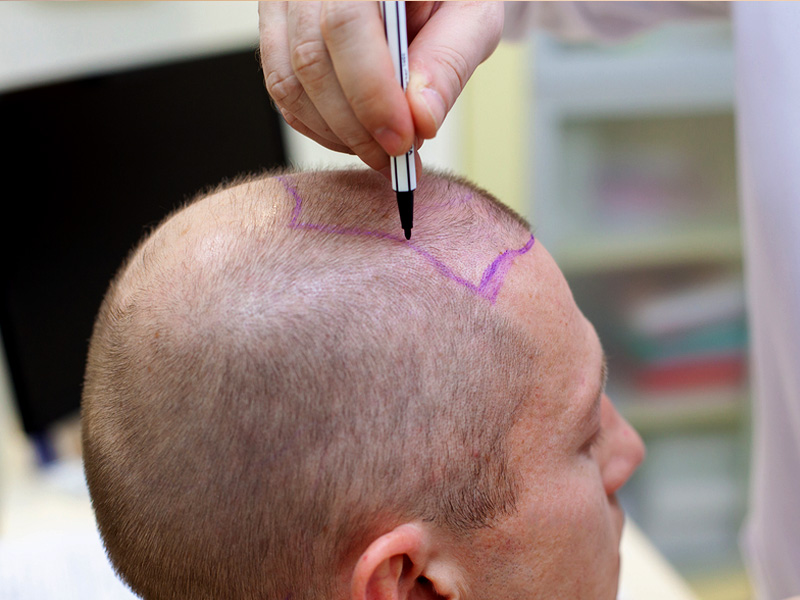 scalp pigmentatie